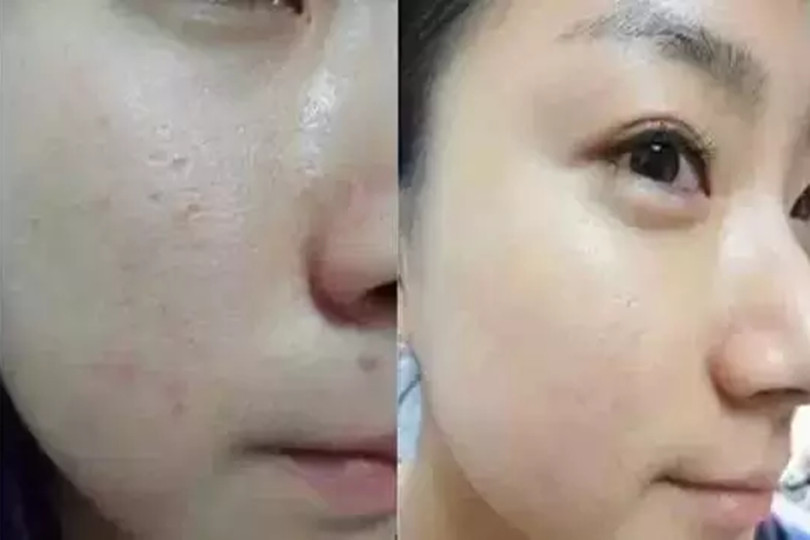 水光注射补水保湿效果对比