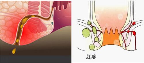 肛瘘是因为肛肠部位受到感染,在病发前期,肛周部位可见脓包,叫做肛周