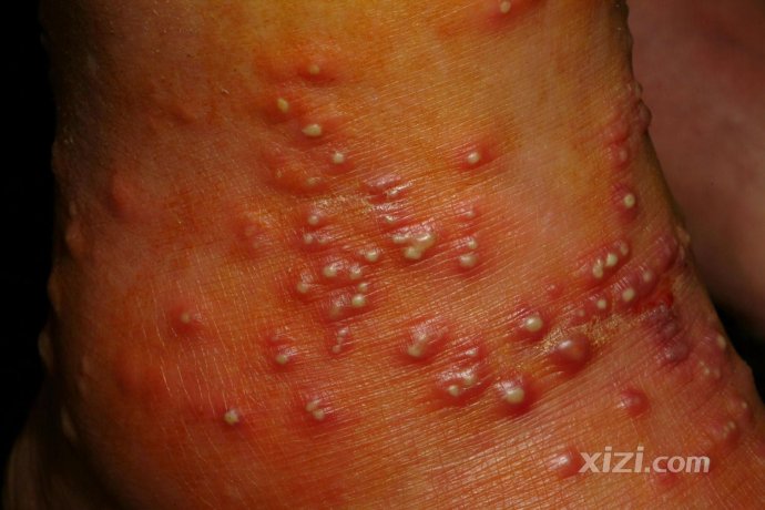 人体被红火蚁咬伤后有如火灼伤般疼痛感,被叮咬的皮肤会出现水泡,在几