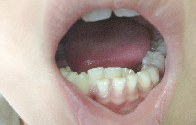 新牙末端是锯齿状 这也属于正常情况,牙齿的末端上的锯齿被牙医称为"