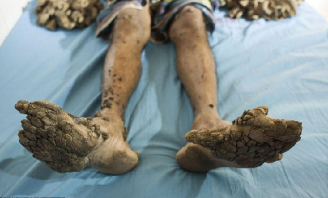 25岁男患罕病 手脚长满疣块犹如「树人」
