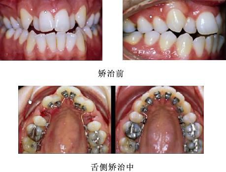 所谓"舌侧隐藏式",顾名思义,就是将矫正器安放在牙齿的内侧(舌