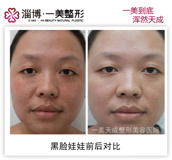黑脸娃娃效果对比做黑脸娃娃有什么副作用吗黑脸娃娃有什么副作用吗